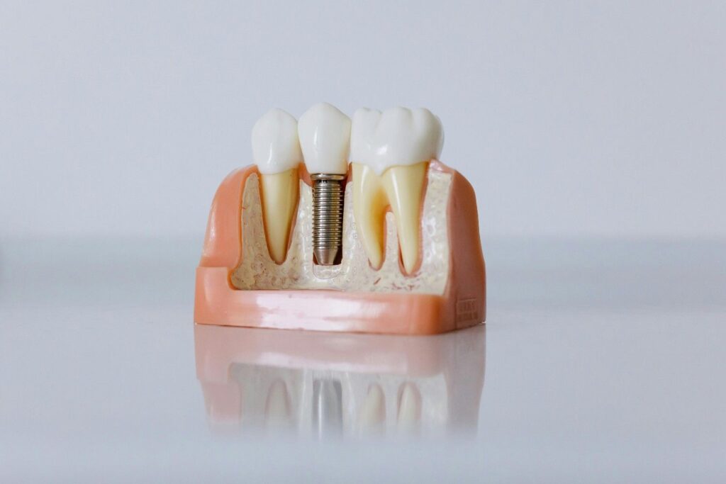 A consultation for dental implants Indianapolis offers a detailed look at your dental history